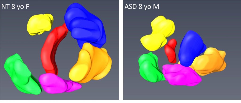 ASD Model